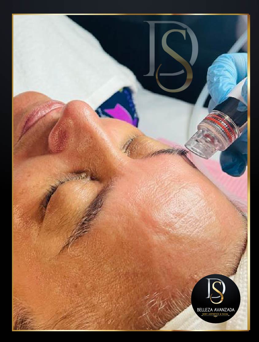 Before and after dermapen results