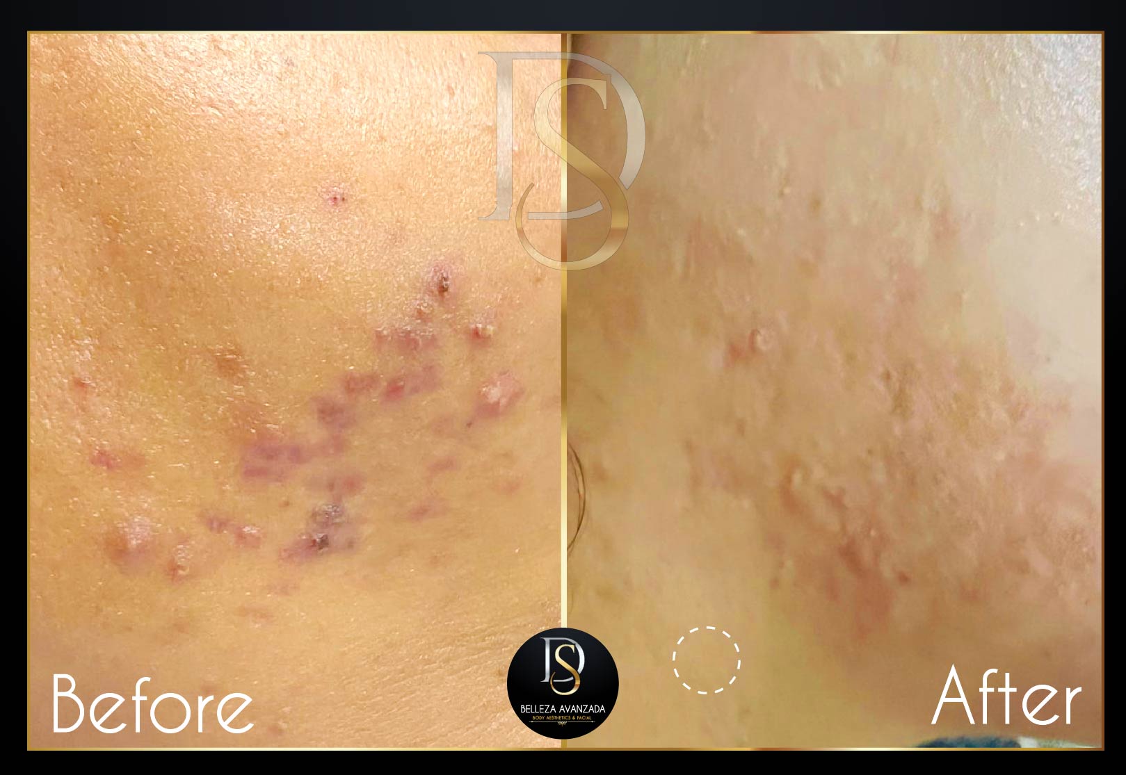 Before and after acne treatment