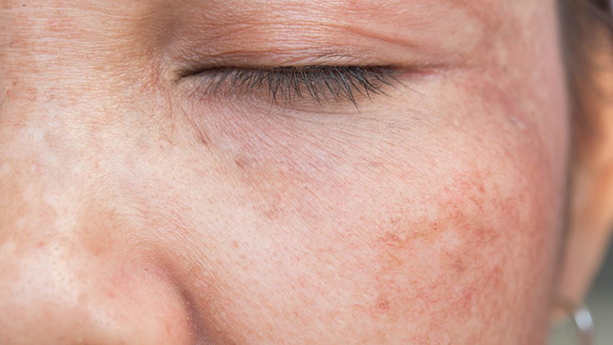 Face pigmentation treatment