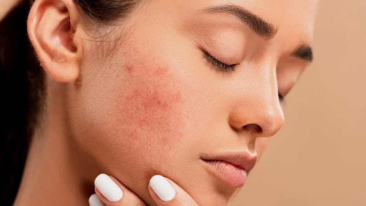 Acne treatment Dallas